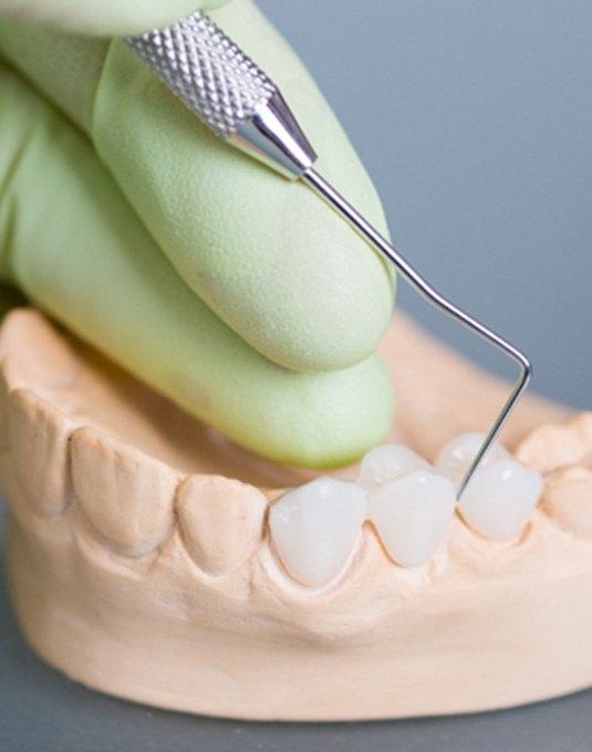 an example of a dental bridge in Cherry Hill