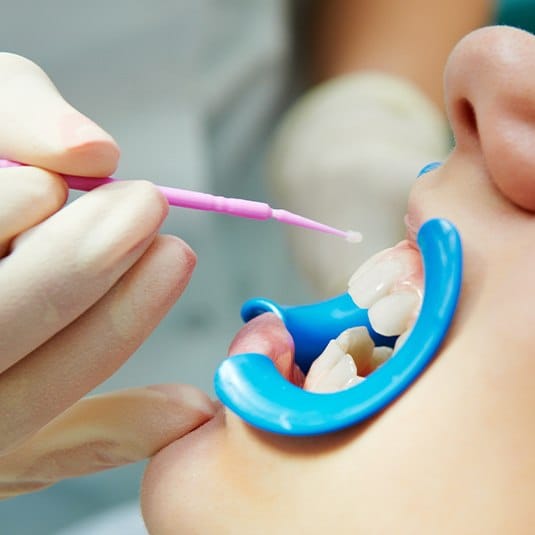 close up of fluoride treatment