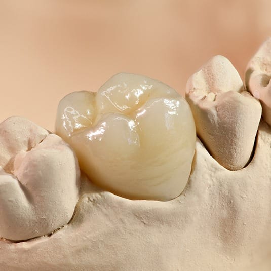 close up of dental crown