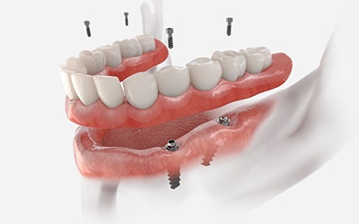 3D render of implant dentures