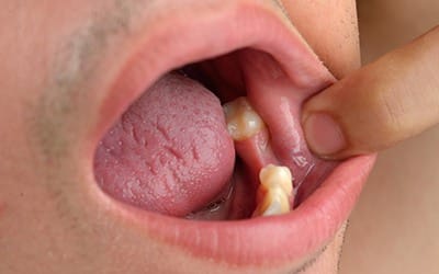 man missing tooth