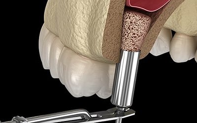 sinus lift procedure