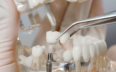 dentist placing a bridge onto dental implants 