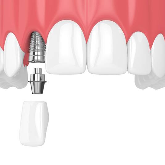 dental implant, abutment, and crown being placed in a patient’s upper jaw 