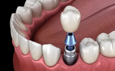 dental crown being placed on top of a single implant post 