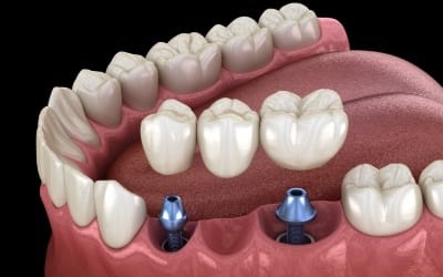 dental bridge being placed on top of two implant posts 