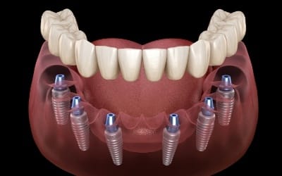implant denture being placed on top of several implant posts 