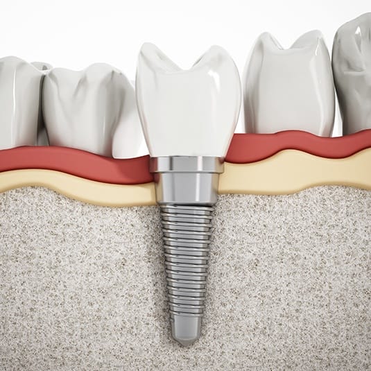 Computer illustration of dental implant