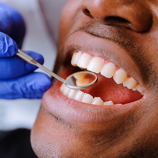 close up of tooth colored fillings