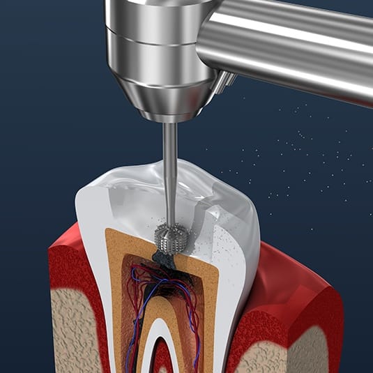 computer illustration of root canal