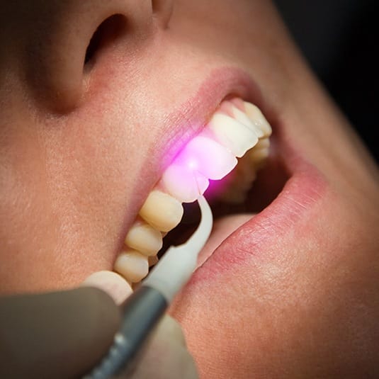 dental laser behind tooth