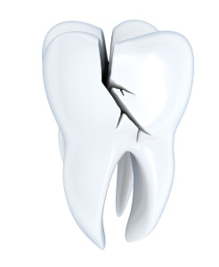 Dental crowns in Cherry Hill require impressions to be made. 