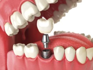 Dental implant for premolar