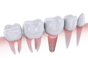 Image of dental implants