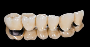 tooth colored porcelain dental bridge