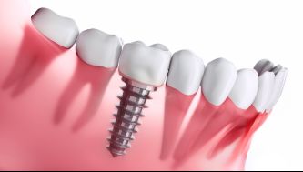 Dental implant in lower jaw