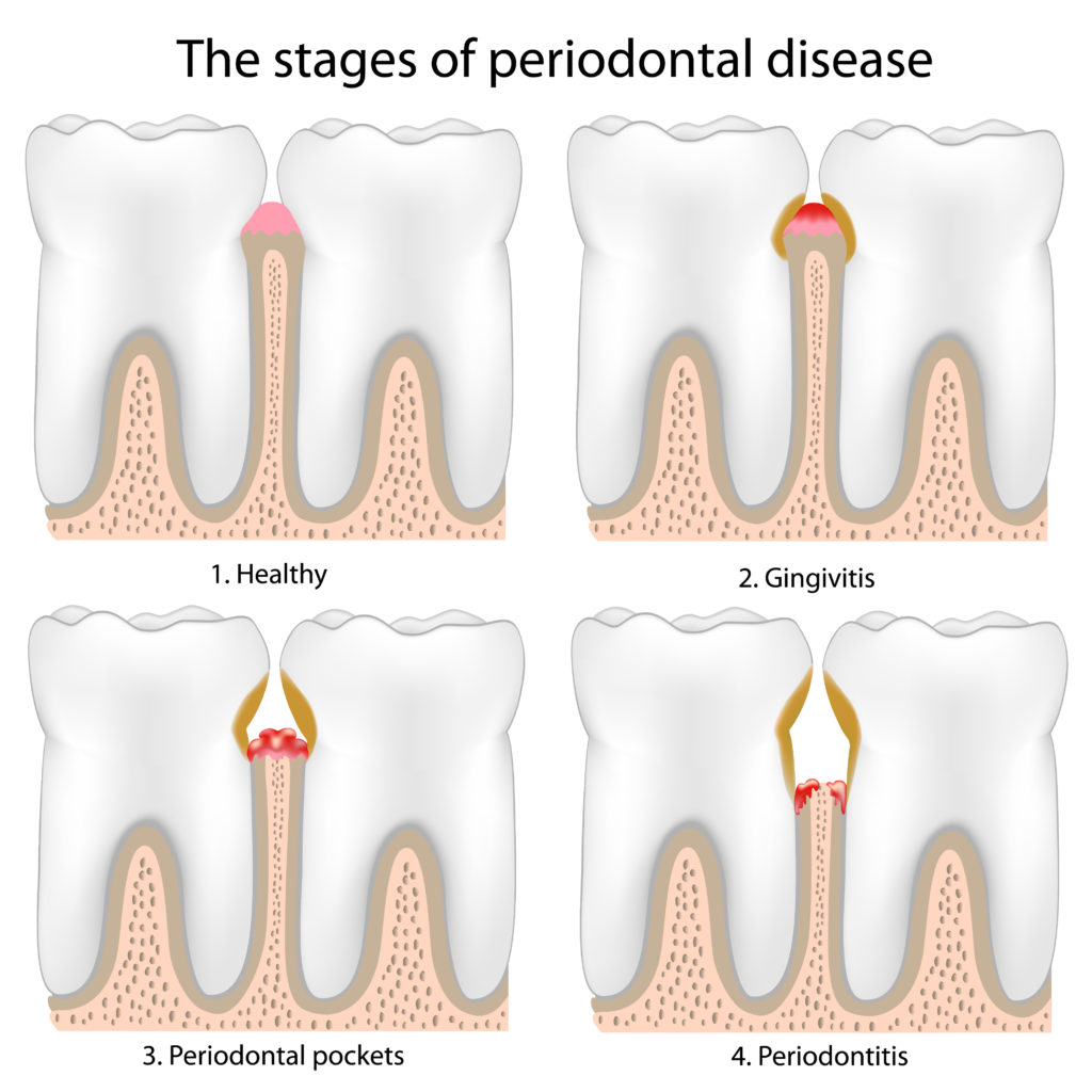 Illustration showing the stages of gum disease