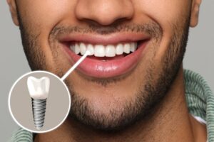 Man with a front tooth dental implant