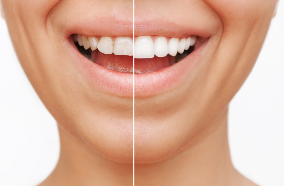 Woman's smile half veneers, half natural teeth